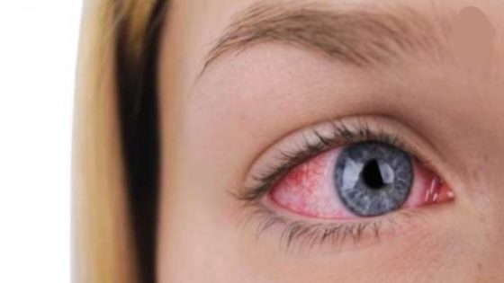 وباء العين الوردية الأعراض والأسباب (معلومات كاملة)